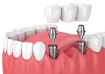 dental-bridge