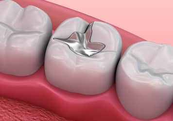 Types of Dental Fillings - Eagle Harbor Dentist