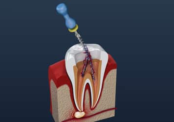root canal grovetown endodontist
